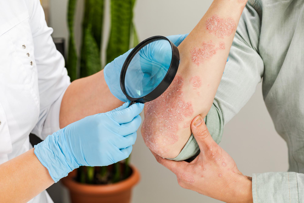 Managing Psoriasis Symptoms with Personalised Supportive Care: A Homeopathy Perspective